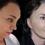 Is a Facelift in Dubai the Right Choice for Your Refresh?